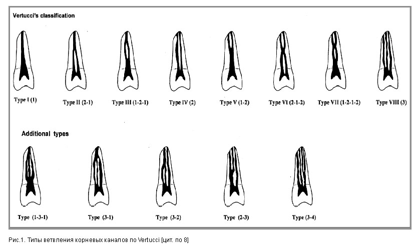 Тип строения зуба. Типы конфигурации корневых каналов по Вертуччи. Анатомия корневых каналов зубов верхней и нижней челюсти. Классификация корневых каналов Vertucci 1984. Классификация корневых каналов Vertucci.